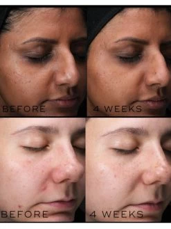 Medik8 Balance Moisturiser With Glycolic Acid Activator -Care Products Store Medik8BalanceMoisturiserWithGlycolicAcidActivatorBeforeAndAfter