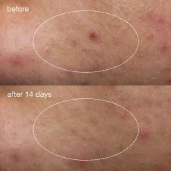 Dermalogica Deep Breakout Liquid Patch 19 Dermalogica Deep Breakout Liquid Patch -Care Products Store dermalogica deep acne liquid patches 1