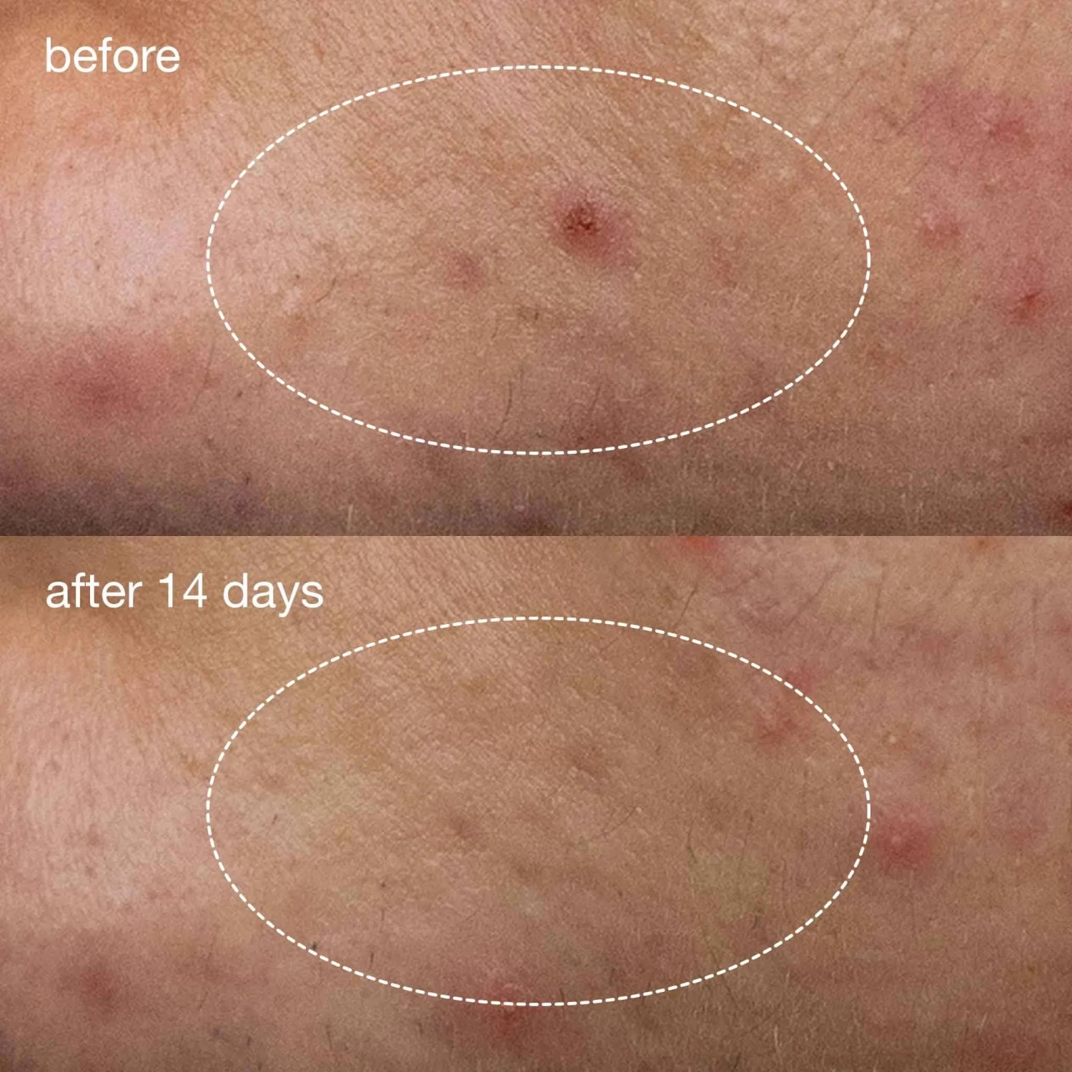 Dermalogica Deep Breakout Liquid Patch 8 Dermalogica Deep Breakout Liquid Patch - Image 8